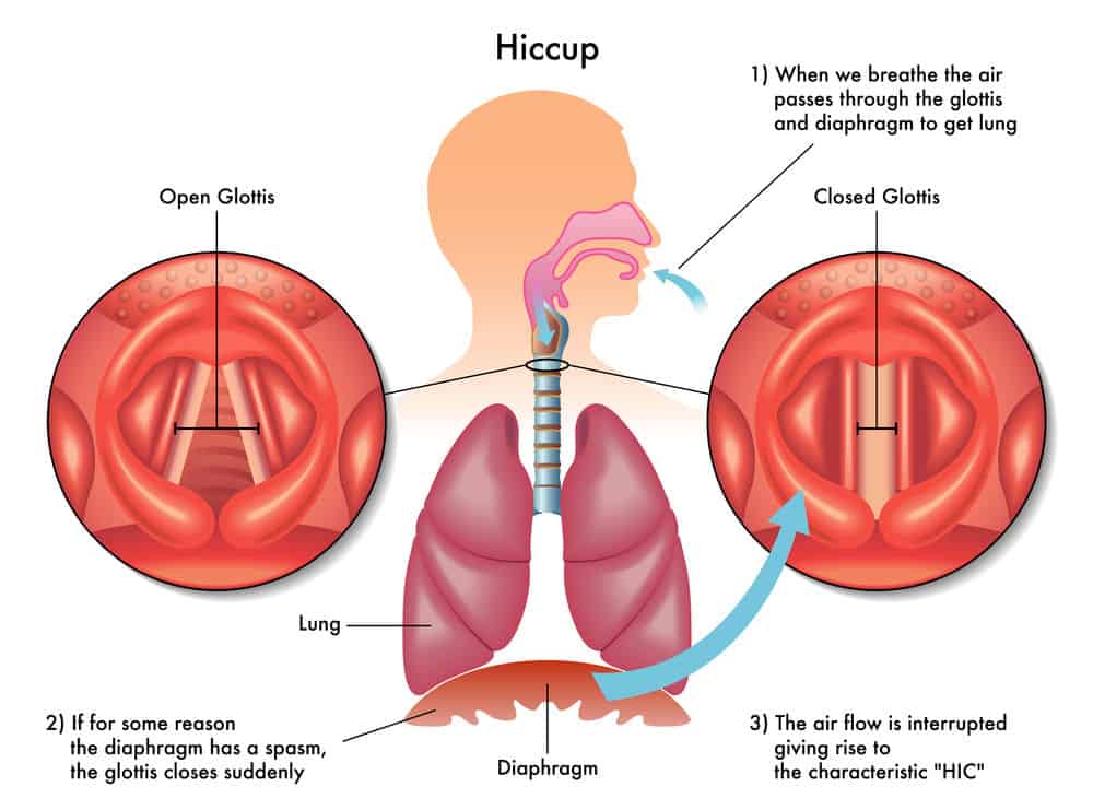 tips-to-stop-hiccups