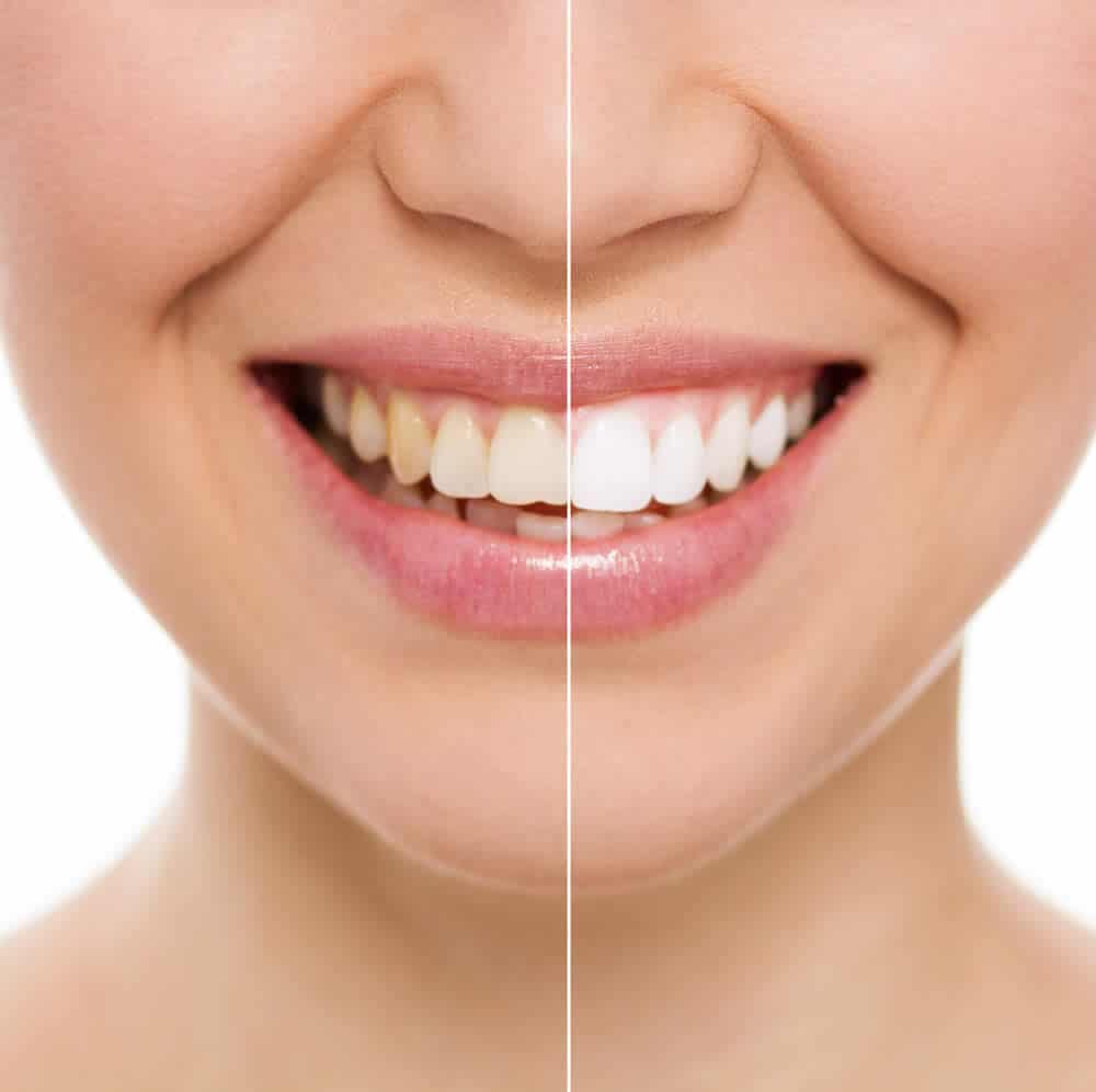 does-turmeric-stain-or-whiten-your-teeth