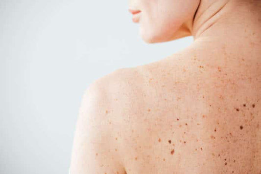 Boost Your Skin Cancer Awareness