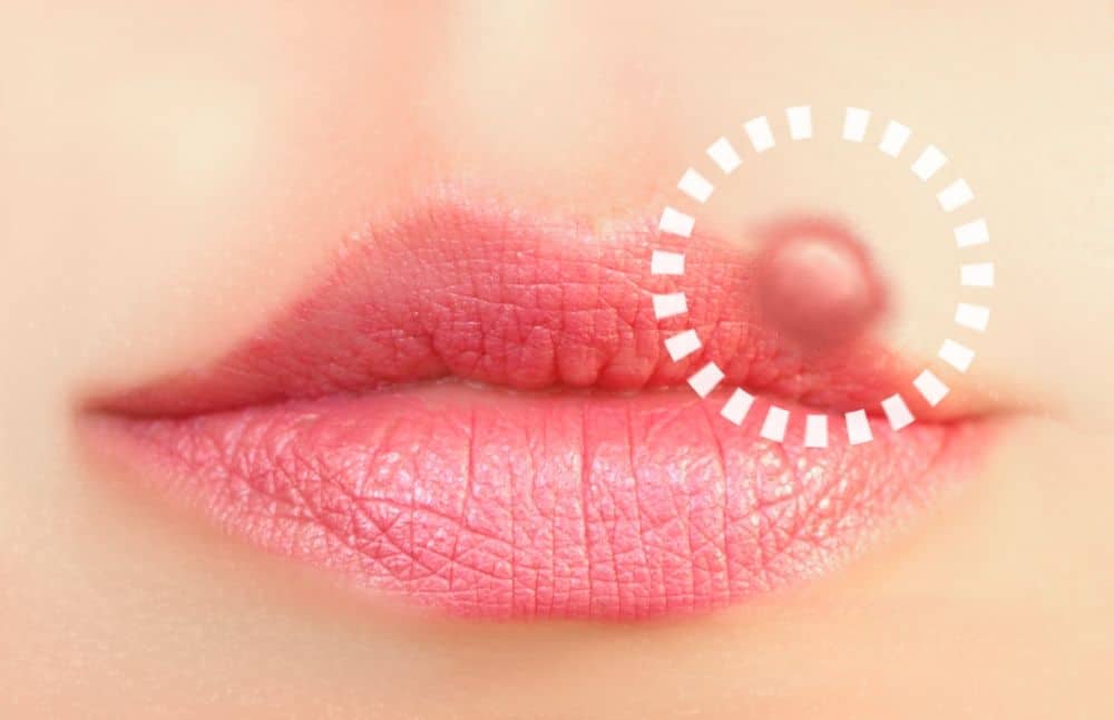 5 STDs That Show Up on Your Mouth and Lips