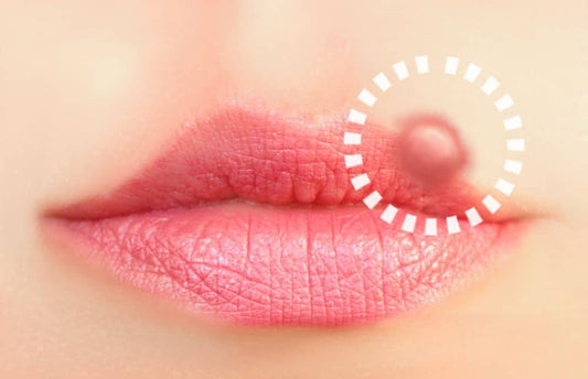 5 STDs That Show Up on Your Mouth and Lips