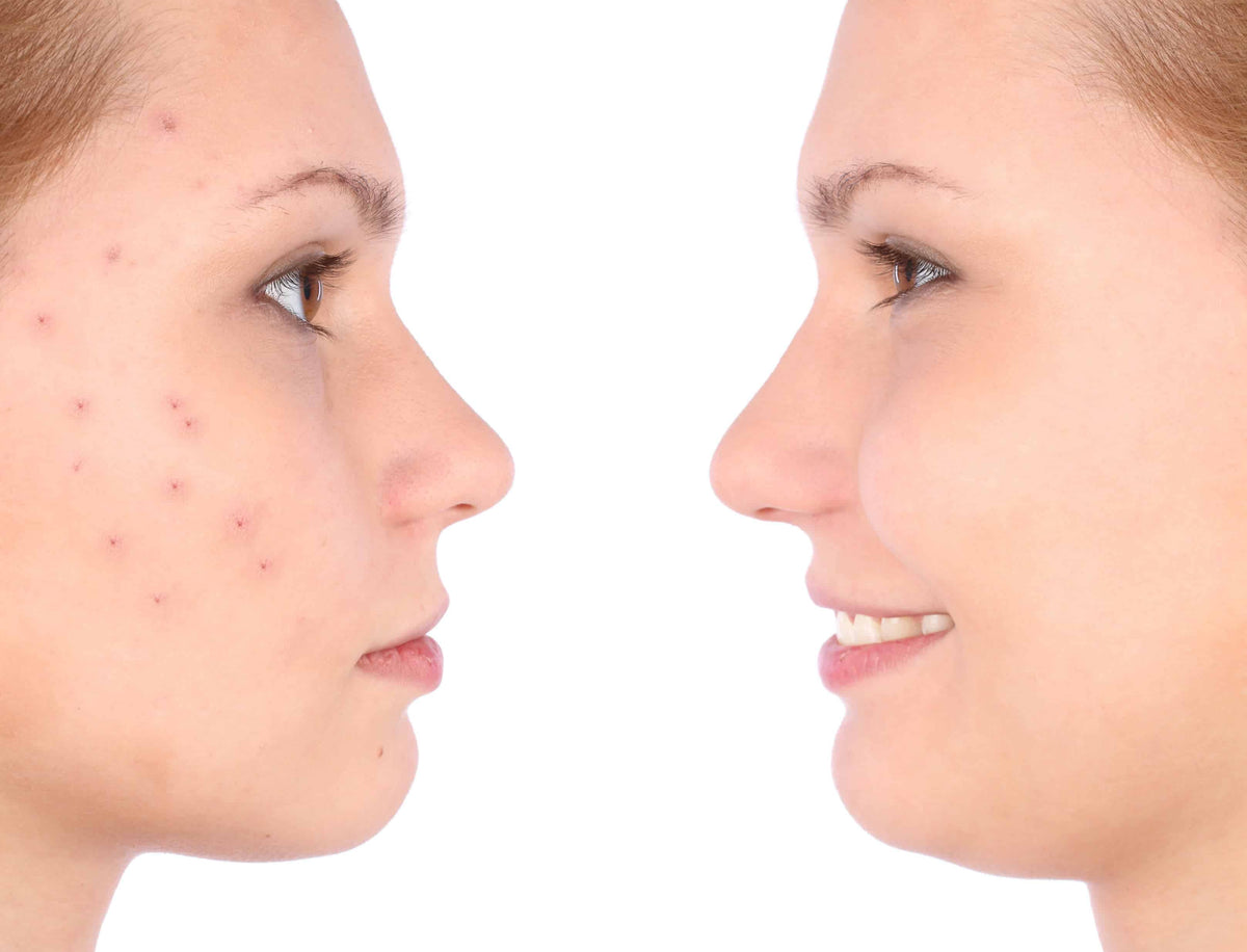 Zap Your Zits Away With Milk Thistle