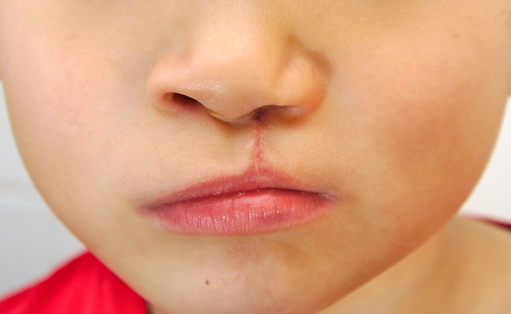 what is the purposes of the philtrum