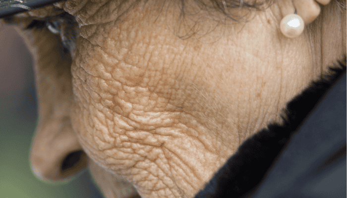 Wrinkled skin could be indicative of low collagen.